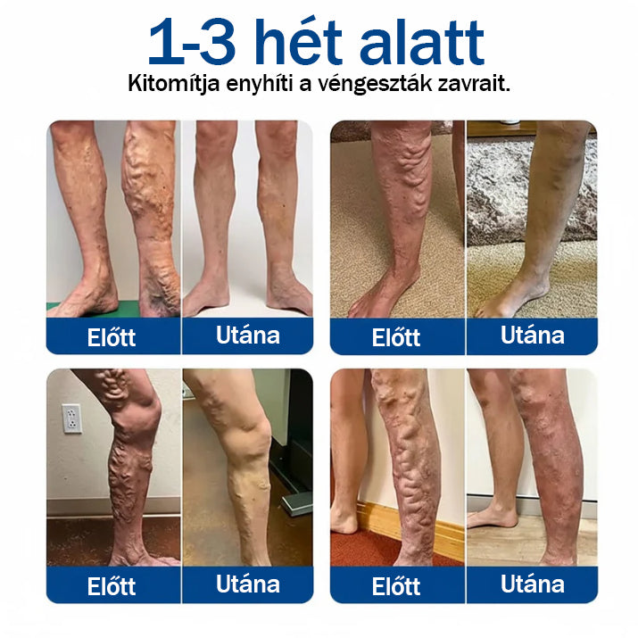✅ Medistart® Visszérápoló Mikrotűs Gondozó Tapasz ⚡ Azonnali Megkönnyebbülés, Hosszú Távú Eredmények
