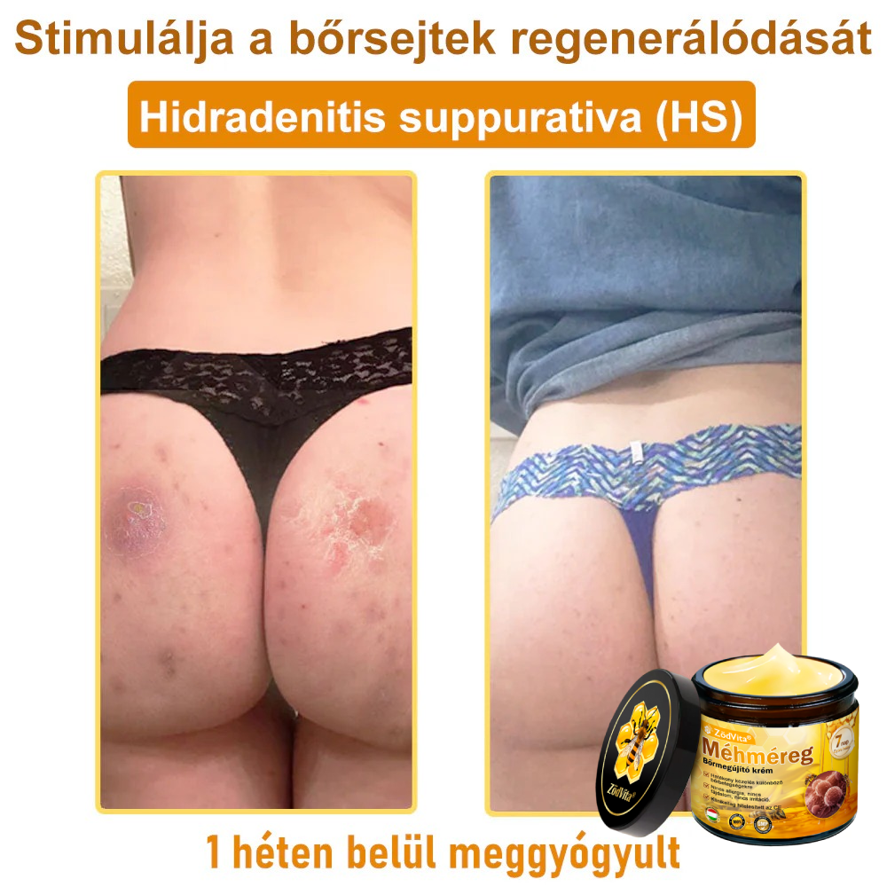 👍🔥🔥ZödVita® Méhméreg Bőr Helyreállító Krém (👨‍⚕‍CE Tanúsítvány)👍👍