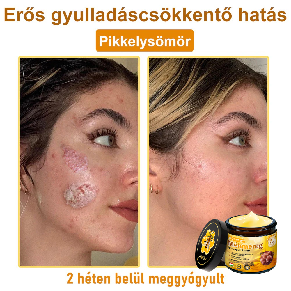 👍🔥🔥ZödVita® Méhméreg Bőr Helyreállító Krém (👨‍⚕‍CE Tanúsítvány)👍👍