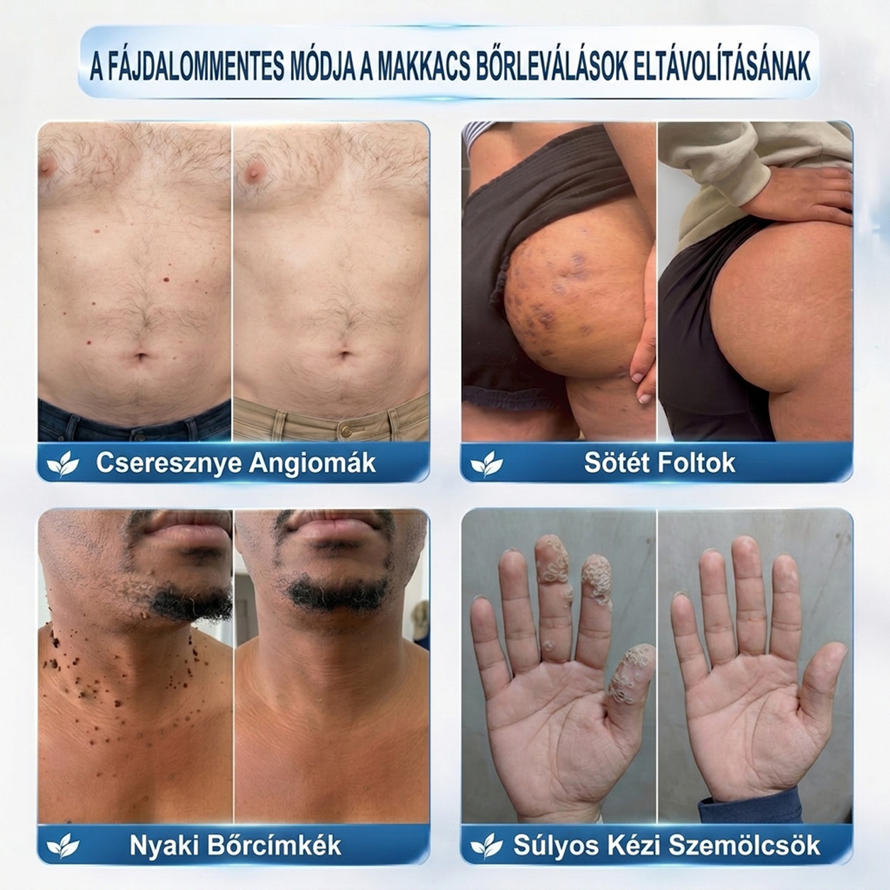 PuraCure® 👩‍⚕️ 𝟕 𝐍𝐚𝐩𝐨𝐬 Bőrkinövés- és Folteltávolító Toll Fájdalommentes és Hegmentes Professzionális Rollerball